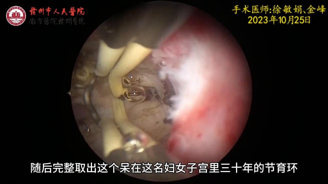 关于元宫型CU365节育环放取视频，你想知道的都在这里