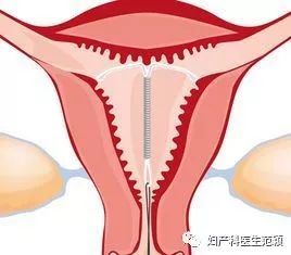 元宫型CU365节育环上环视频，一个真实到让你手心出汗的全程记录