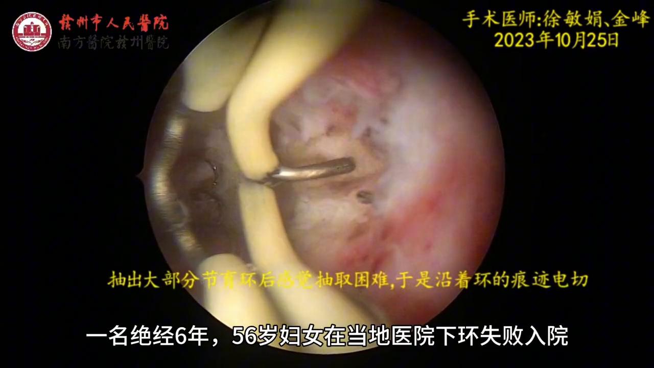 元宫型cu365节育环视频，你想了解的，我一次性说清楚